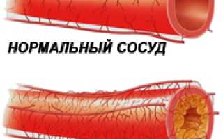 Причины, симптомы, диагностика и методы лечения атеросклероза у пациентов