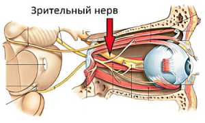 Неврит зрительного нерва: причины и симптомы