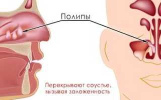 Полипозный синусит: лечение, причины и симптомы заболевания