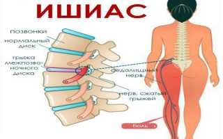 Как лечить ишиас? Причины и симптомы заболевания