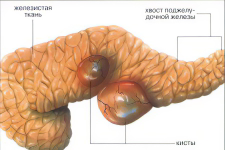 Киста поджелудочной железы