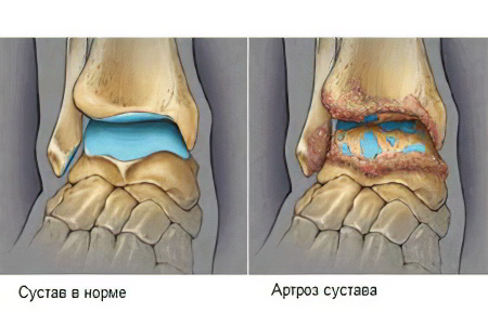 Артроз голеностопного сустава