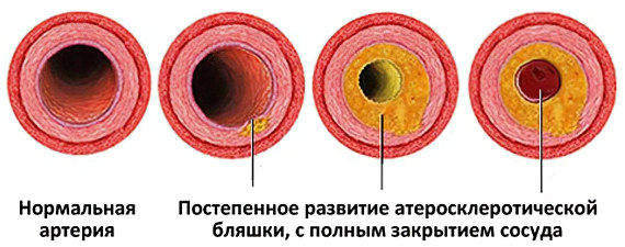 Причины атеросклероза