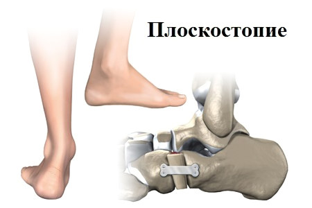 Хирургическая коррекция