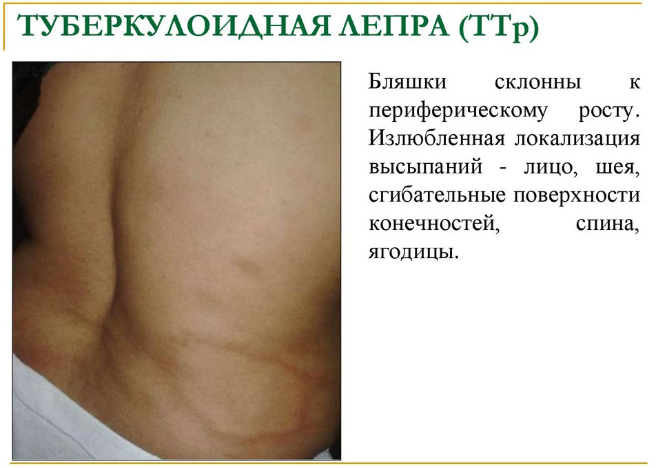 Лепра туберкулоидной формы