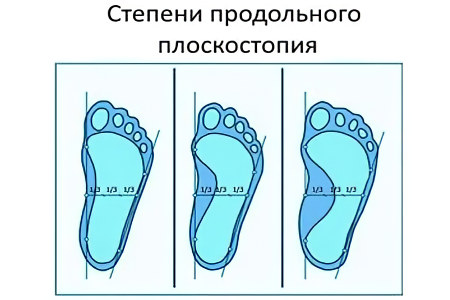 Продольное плоскостопие