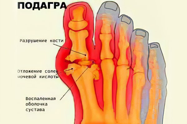 Подагра