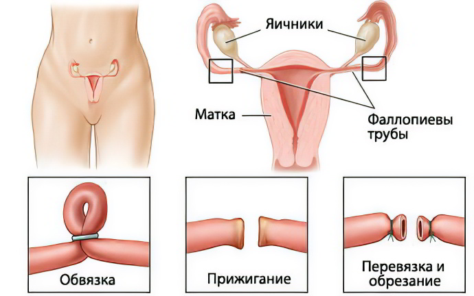 Перевязка маточных труб