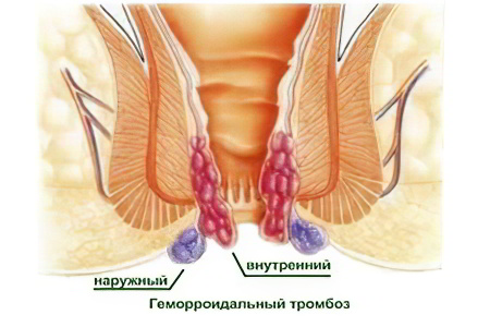Тромбоз