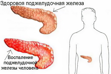 воспаления поджелудочной железы